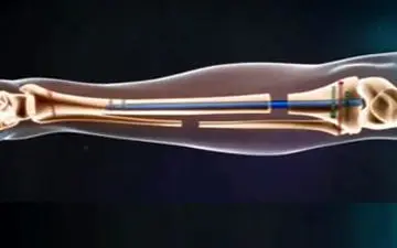 فیلمی جالب از نحوه‌ی عمل جراحی افزایش قد!