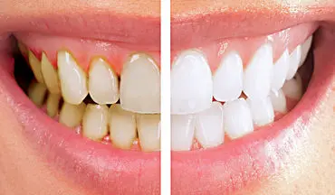 ۱۰ روش طبیعی برای سفید کردن دندان‌ها بدون مراجعه به دندان‌پزشک
