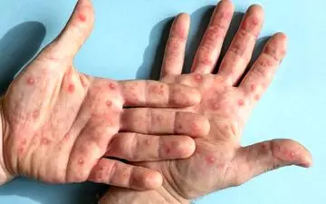  مبتلا به «آبله مرغان» این داروها را مصرف نکنند!

