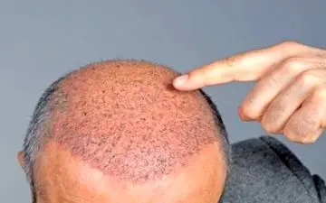 نکات مهمی که قبل از کاشت مو