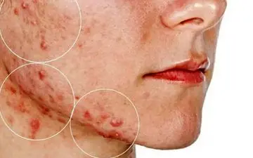 برای سلامت پوست چکار کنیم؟| لمس صورت باعث بروز و یا تشدید آکنه می شود؟