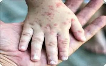 علت افزایش بروز «آبله‌مرغان» چیست؟