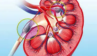 تشخیص سنگ کلیه با یک تلفن همراه! 