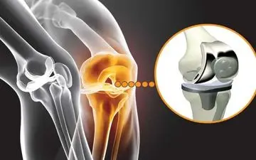 اقدامات درمانی بعد از تعویض مفصل زانو