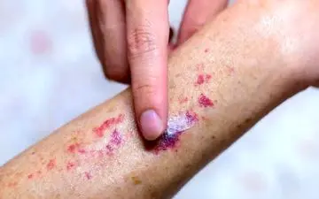 
علائم هپاتیت که برروی پوست ظاهر می شوند کدامند؟