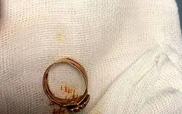 سرنوشت زن کرونایی و انگشتری که جهانی شد!