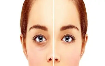 نکاتی مهم برای افرادی که قصد جراحی پلک دارند