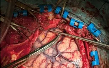  بهترین زمان برای درمان سکته مغزی حاد