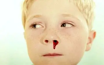 چرا خون دماغ می شویم؟