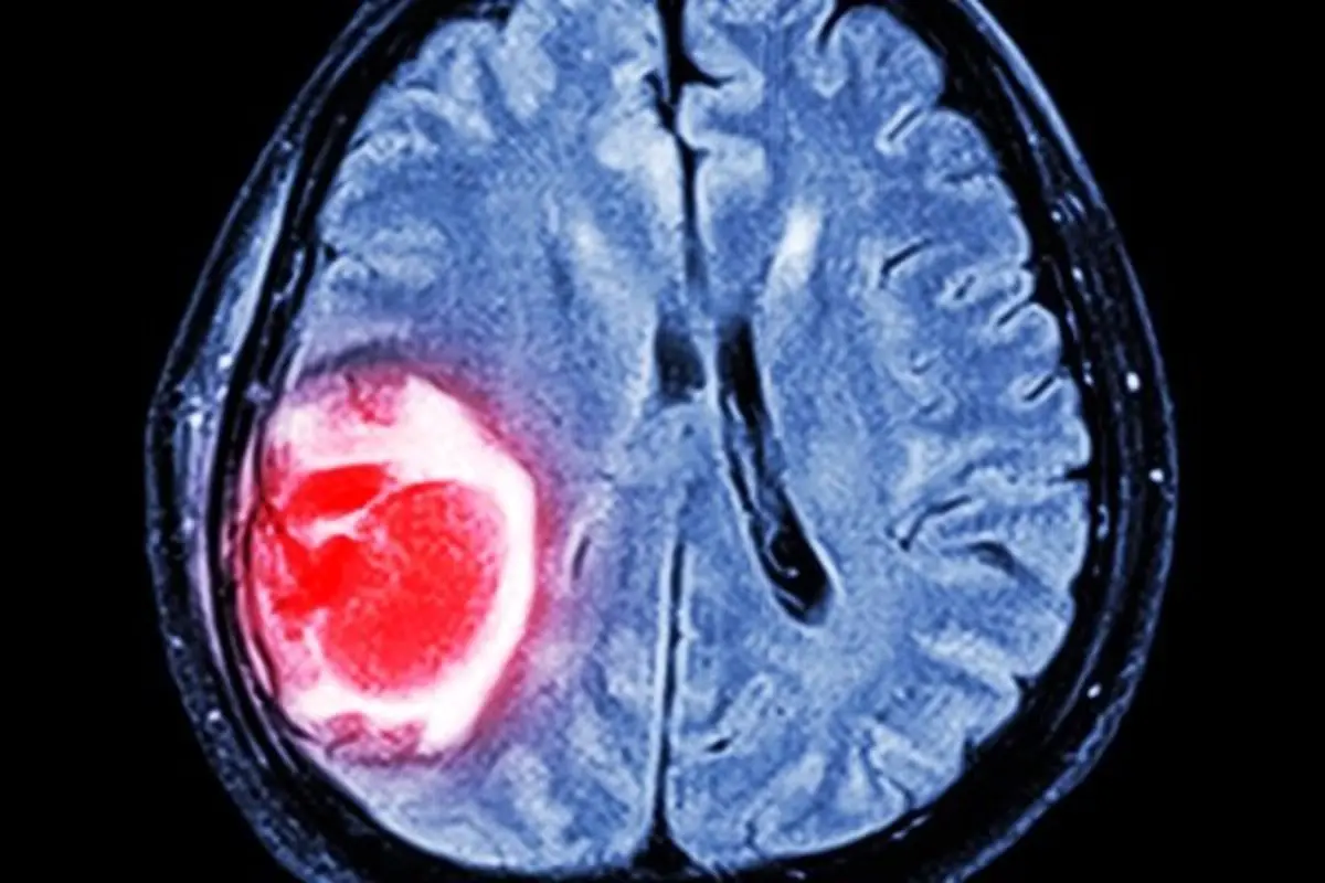 داروی ضدمالاریا موثر در بهبود سرطان مغز 