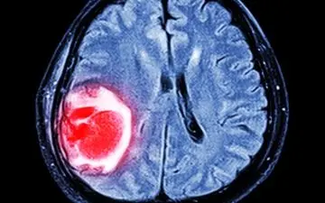 داروی ضدمالاریا موثر در بهبود سرطان مغز 