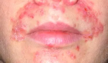 علل قرمزی و تورم دور دهان کودکان چیست؟