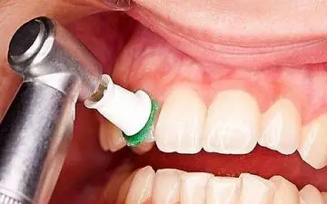 جرم‌گیری باعث آسیب دندان می شود؟

