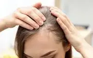 ریزش مو دارید؟ پس حتما این مطلب را بخوانید!
