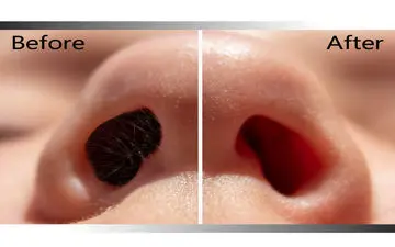 خداحافظی با موهای زائد بینی: راهکارهای آسان و موثر
