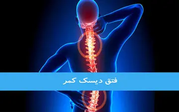درمان فتق دیسک کمر