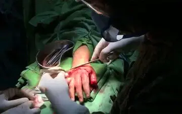 مراحل پیوند دست زن شیرازی که با ساطور قطع شده بود 