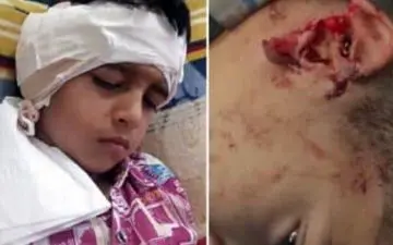 
روایت هولناک حمله سگ ها/ گوش پسرک را جویدند