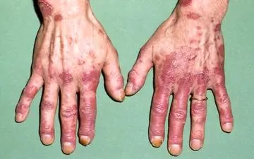 لوپوس در کودکان خطرناک‌تر و پیشرونده‌تر است