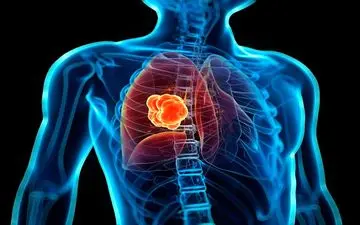  شایع‌ترین علت نارسایی قلب