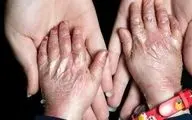 سهمیه تابستان پانسمان‌های تخصصی به خانه EB تحویل شد