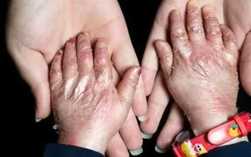 سهمیه تابستان پانسمان‌های تخصصی به خانه EB تحویل شد