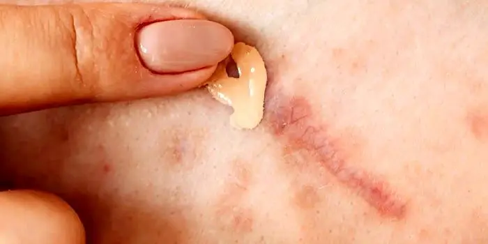 پوشاندن جای زخم با آرایش