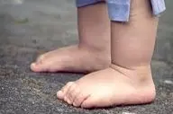 کف پای صاف در کودکان چه هنگام خطرناک است؟