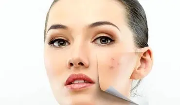 روش های خانگی برای از بین بردن لک صورت