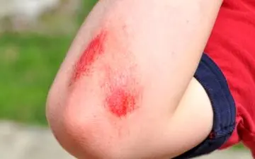 درمان خانگی خراشیدگی پوست 