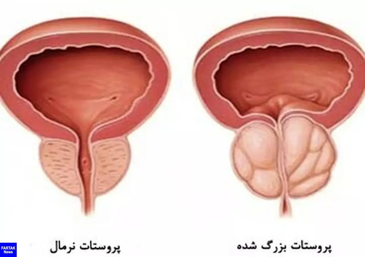 پیشگیری از بزرگی پروستات بدون دارو

