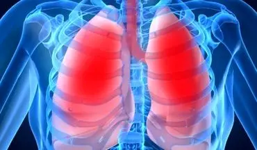 6عامل اصلی که باعث آسم می شود