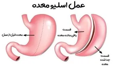 آنچه در مورد جراحی اسلیو معده باید بدانید