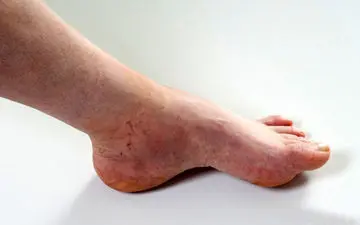 مهمترین عامل اثر گذار در ابتلا به واریس