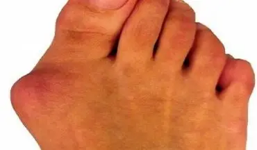 روش های جلوگیری از انحراف انگشت شست پا