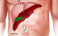 این علائم را جدی بگیرید چون نشانه نارسایی کبدی است!