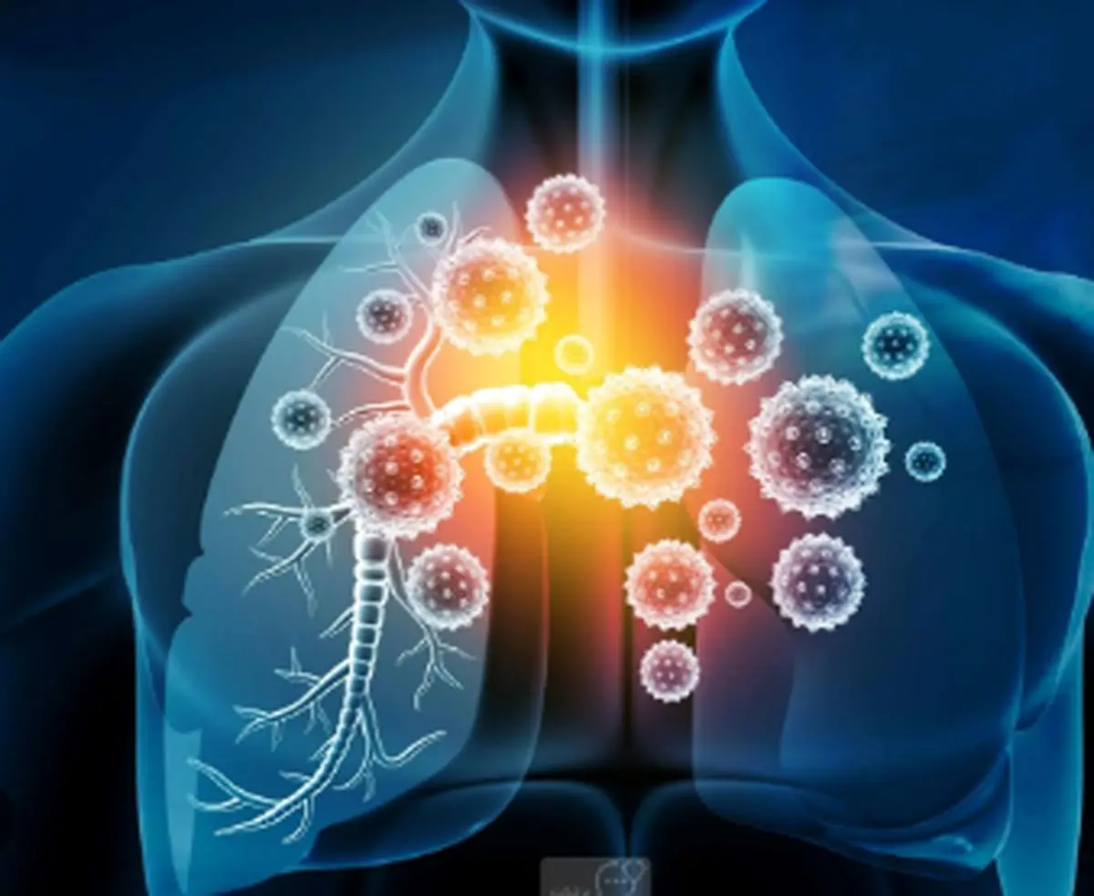 بیماری التهابی ریه را جدی بگیرید!