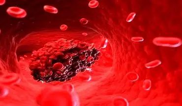 لخته شدن خون در بدن | علائم لخته شدن خون را بشناسید
