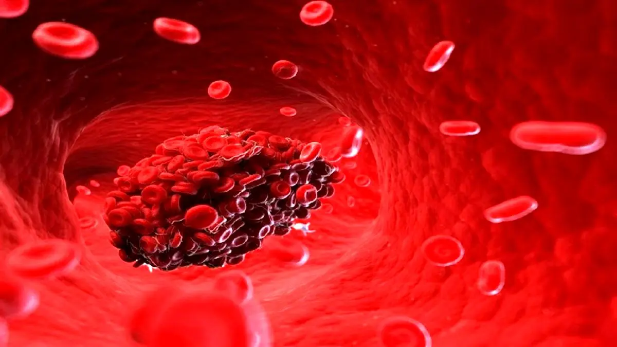 لخته شدن خون چه علائمی دارد؟