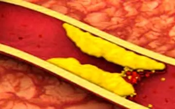 چطور با تغذیه کلسترول را کنترل کنیم؟ 