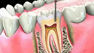 عصب کشی دندان چگونه انجام می‌شود؟ + فیلم
