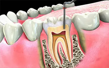 عصب کشی دندان چگونه انجام می‌شود؟ + فیلم