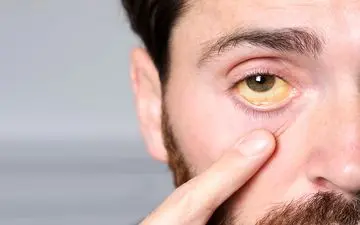 زردی بزرگسالان چیست؟ + راه درمان (علائم و علت زردی در بزرگسالان)