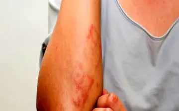 درمان دارویی خارش پوست