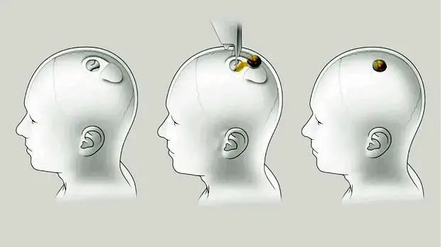 تراشه های Neuralink