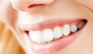 جرم گیری برای سفید شدن دندان ها نیست