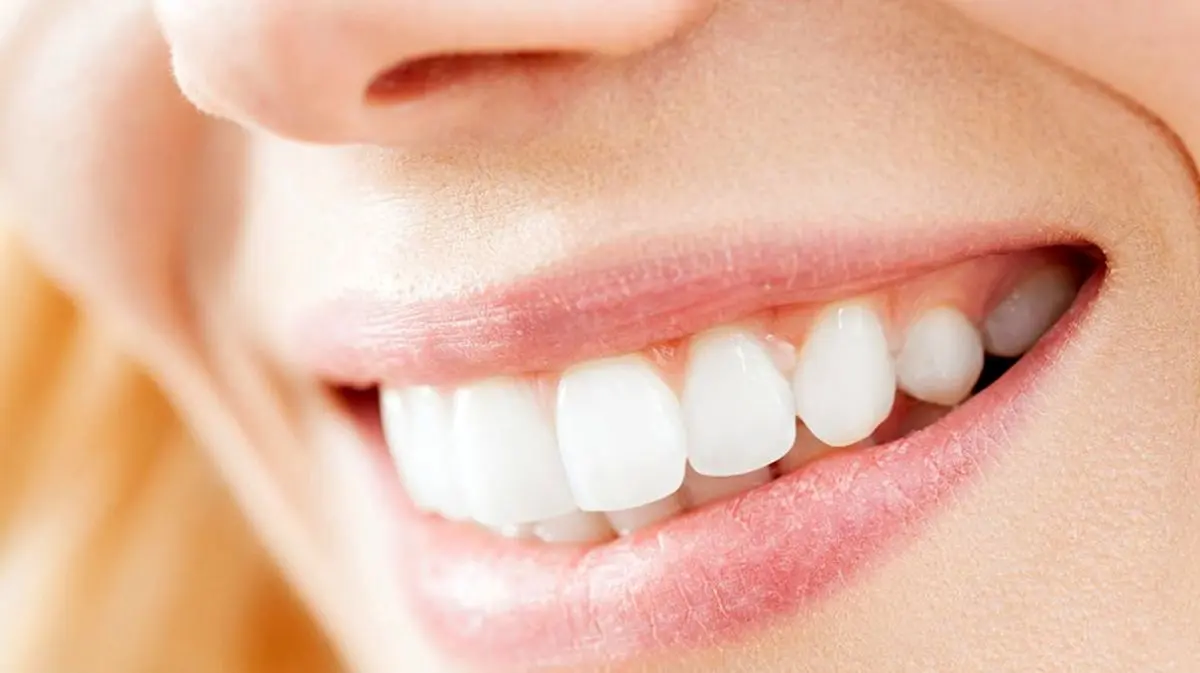 جرم گیری برای سفید شدن دندان ها نیست