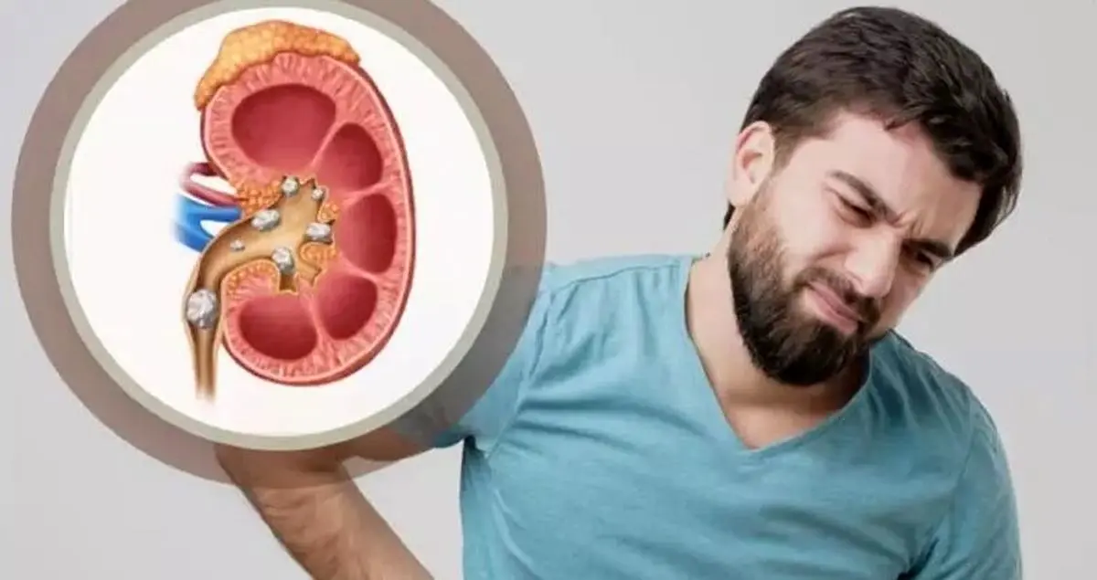   مبتلایان به سنگ کلیه دور این مکمل‌ها را خط بکشند 