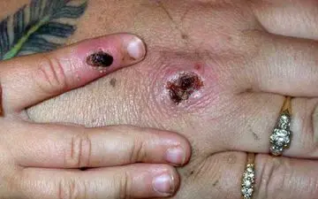 آبله میمونی به زادگاه کرونا رسید