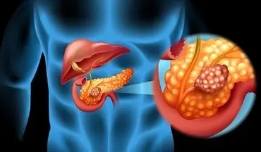 میکروب‌های دهانی؛ عامل مخفی در افزایش خطر سرطان پانکراس